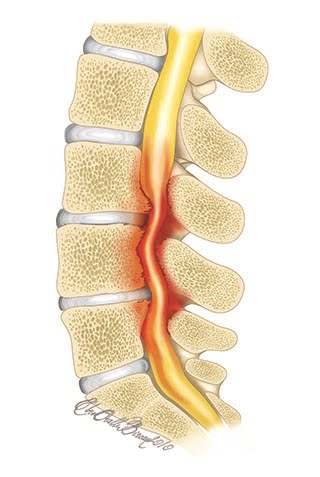 Spinal Stenoz (Kanal Daralması)